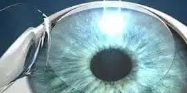 cataract surgery 1