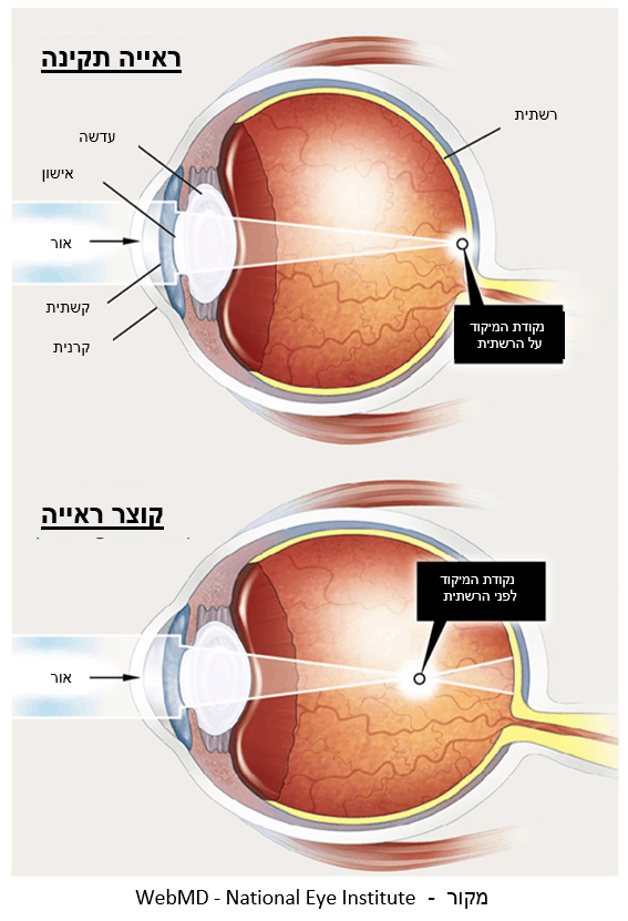 המאמר המקיף ביותר על כל הדרכים לעצירת קוצר ראייה