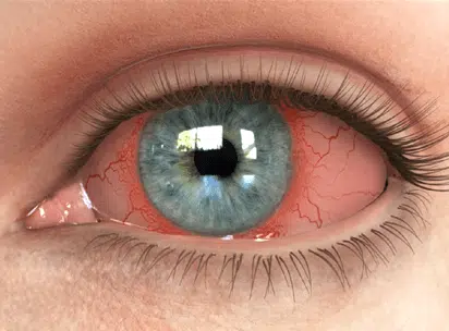 עין יבשה - dry eye