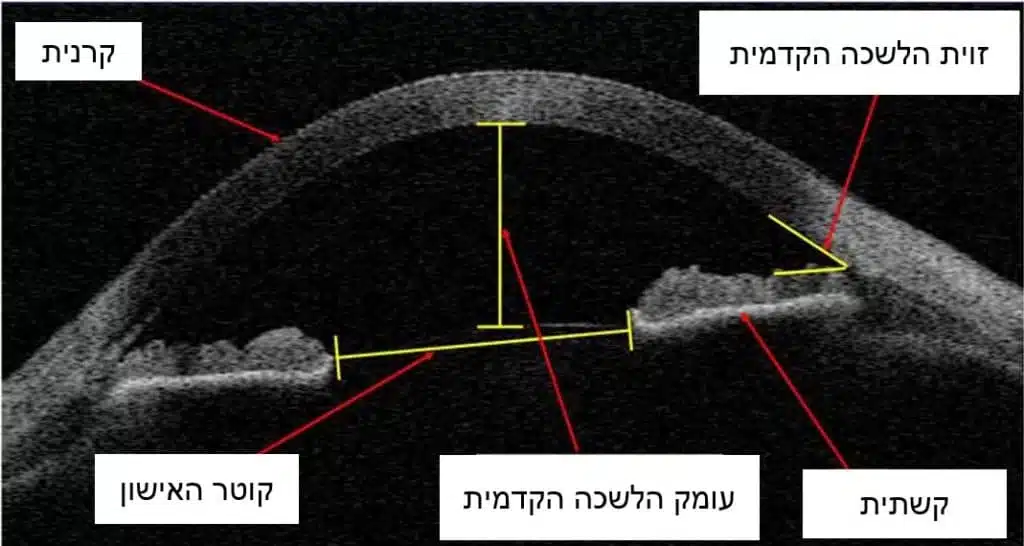 CT - OCT של העין