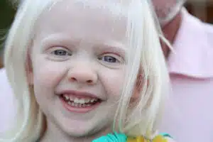 לבקנות עינית - ocular albinism