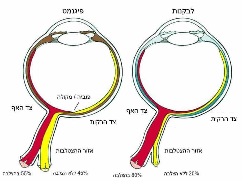 הצלבת עצבי העין