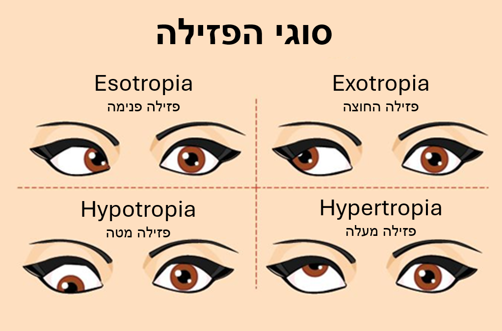 פזילה