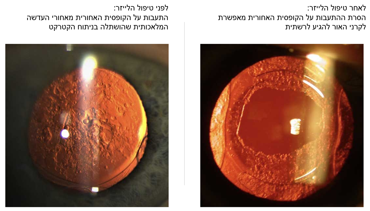 YAG קפסולוטומיה