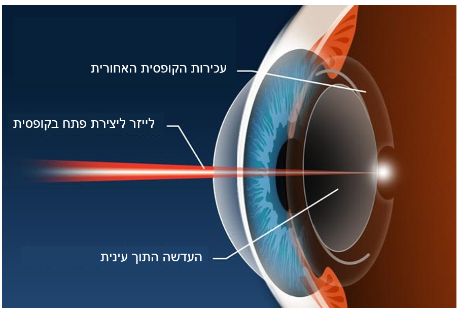 קטרקט משני